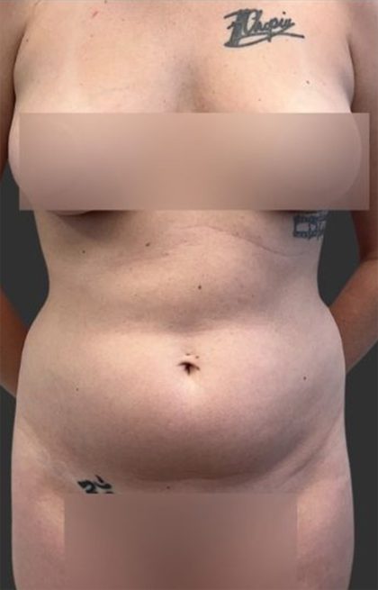 Brazilian Butt Lift Before & After Patient #11998