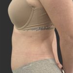Brazilian Butt Lift Before & After Patient #11998