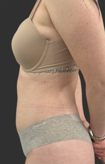 Brazilian Butt Lift Before & After Patient #11998