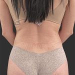 Brazilian Butt Lift Before & After Patient #11998