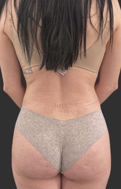 Brazilian Butt Lift Before & After Patient #11998
