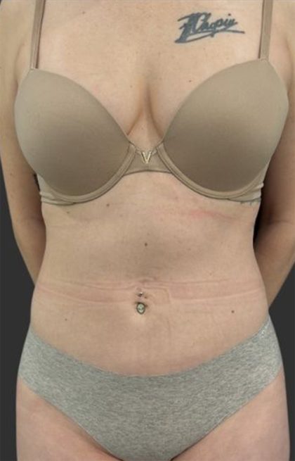 Brazilian Butt Lift Before & After Patient #11998