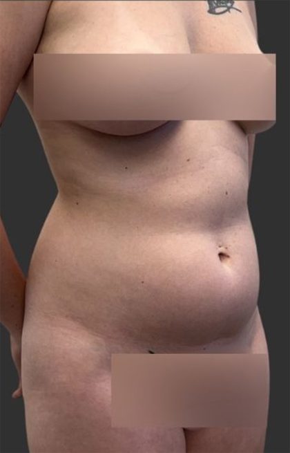 Brazilian Butt Lift Before & After Patient #11998