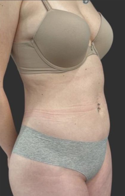 Brazilian Butt Lift Before & After Patient #11998