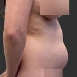 Brazilian Butt Lift Before & After Patient #11998