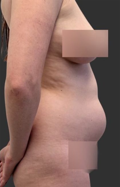 Brazilian Butt Lift Before & After Patient #11998