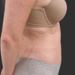Brazilian Butt Lift Before & After Patient #11998
