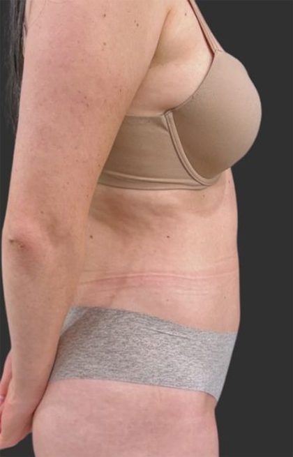 Brazilian Butt Lift Before & After Patient #11998