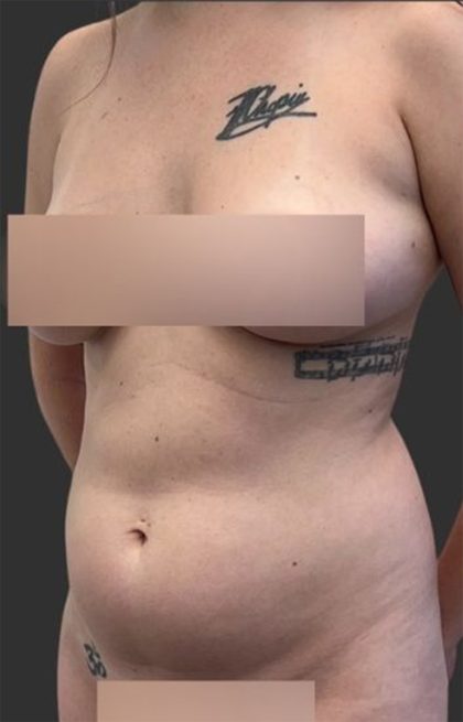 Brazilian Butt Lift Before & After Patient #11998