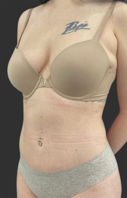 Brazilian Butt Lift Before & After Patient #11998