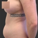 Brazilian Butt Lift Before & After Patient #11998