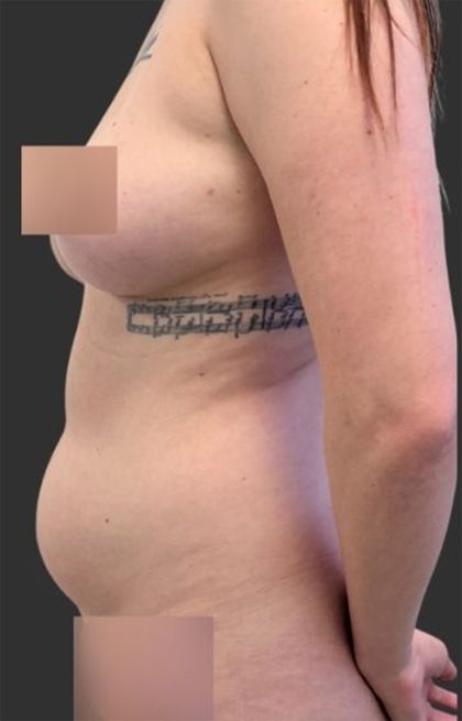 Brazilian Butt Lift Before & After Patient #11998