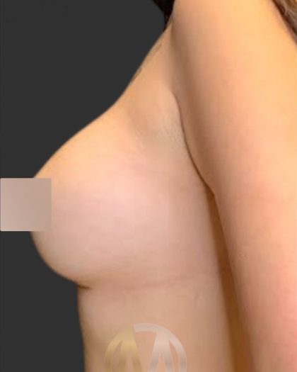 Breast Augmentation Before & After Patient #12000