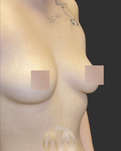 Breast Augmentation Before & After Patient #12000