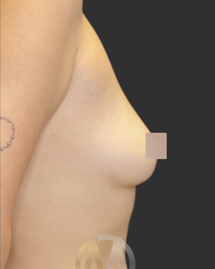 Breast Augmentation Before & After Patient #12000