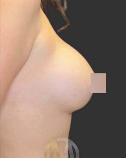 Breast Augmentation Before & After Patient #12000