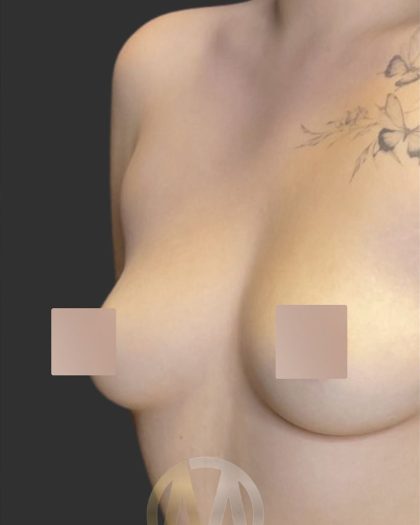 Breast Augmentation Before & After Patient #12000