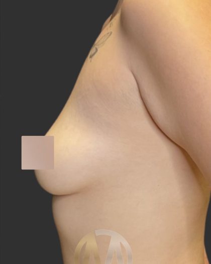 Breast Augmentation Before & After Patient #12000