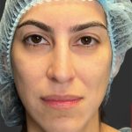 Rhinoplasty Before & After Patient #11999