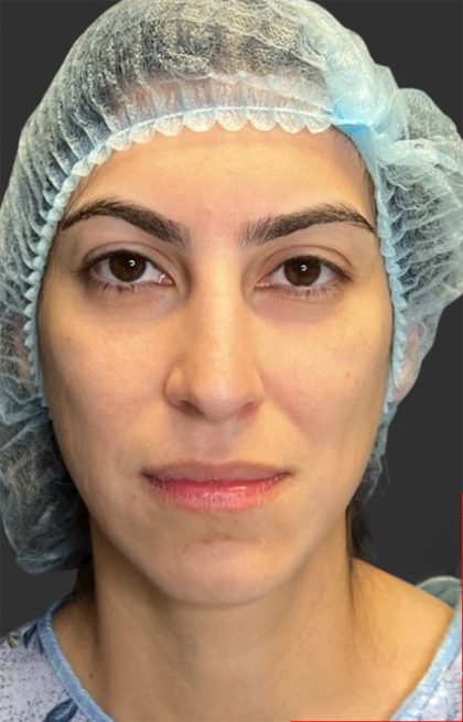 Rhinoplasty Before & After Patient #11999