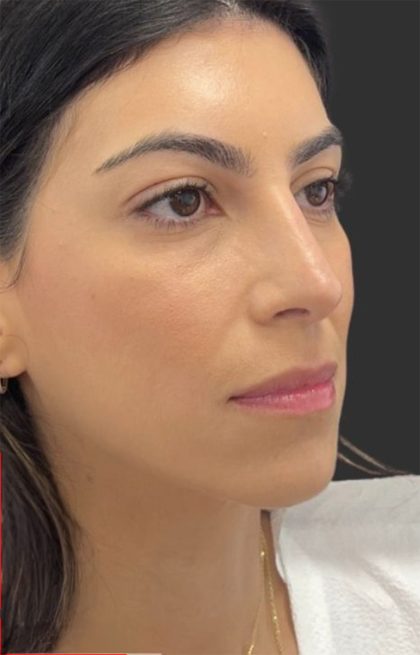 Rhinoplasty Before & After Patient #11999