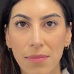 Rhinoplasty Before & After Patient #11999