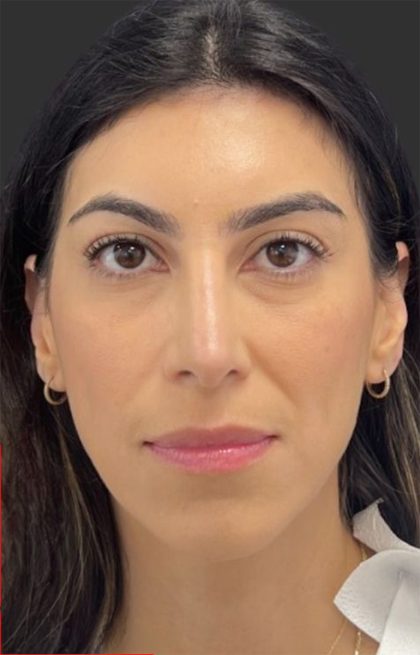 Rhinoplasty Before & After Patient #11999