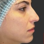 Rhinoplasty Before & After Patient #11999
