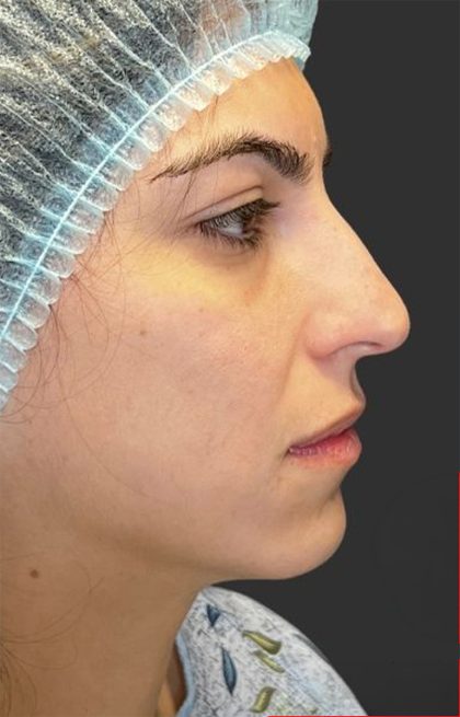 Rhinoplasty Before & After Patient #11999