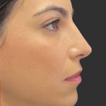 Rhinoplasty Before & After Patient #11999