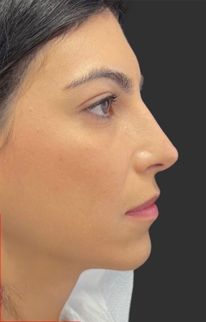 Rhinoplasty Before & After Patient #11999
