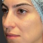 Rhinoplasty Before & After Patient #11999