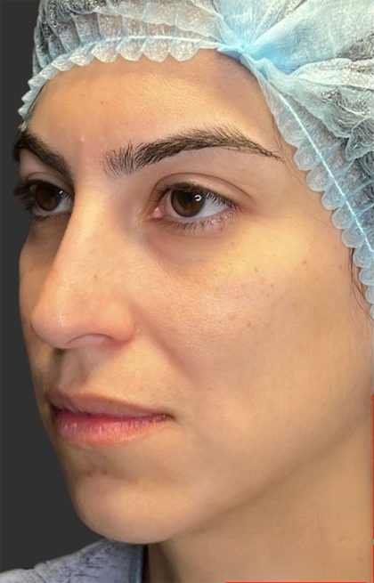 Rhinoplasty Before & After Patient #11999
