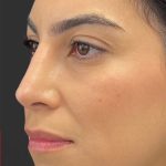 Rhinoplasty Before & After Patient #11999