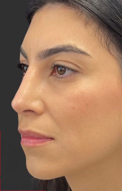 Rhinoplasty Before & After Patient #11999
