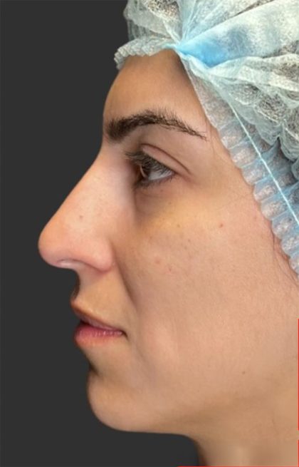 Rhinoplasty Before & After Patient #11999