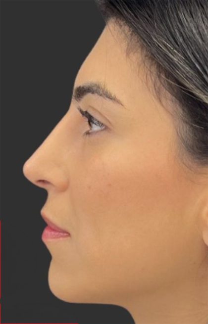 Rhinoplasty Before & After Patient #11999