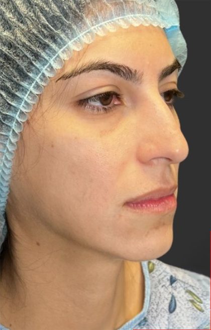 Rhinoplasty Before & After Patient #11999