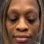 Rhinoplasty Before & After Patient #12001