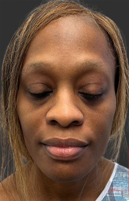 Rhinoplasty Before & After Patient #12001