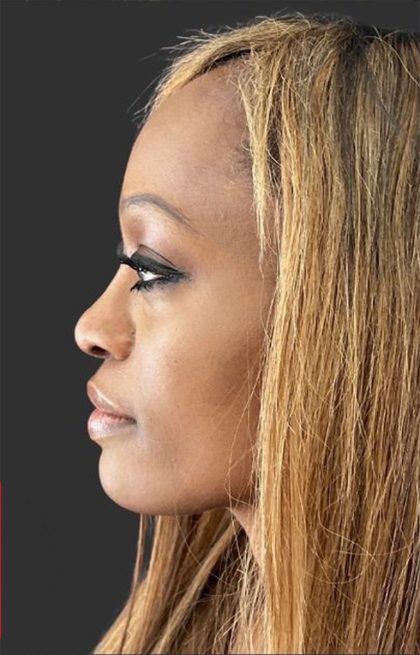 Rhinoplasty Before & After Patient #12001