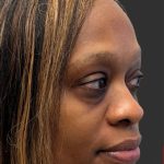 Rhinoplasty Before & After Patient #12001