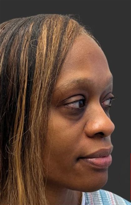 Rhinoplasty Before & After Patient #12001
