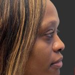 Rhinoplasty Before & After Patient #12001