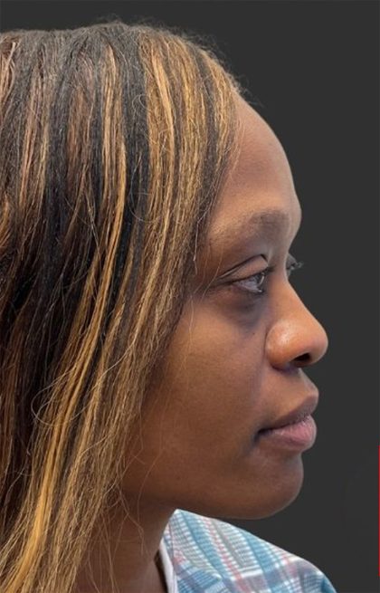 Rhinoplasty Before & After Patient #12001