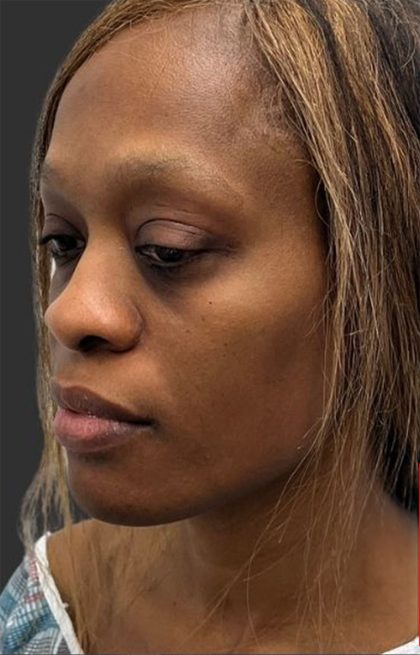 Rhinoplasty Before & After Patient #12001