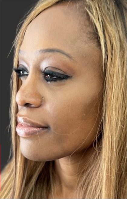 Rhinoplasty Before & After Patient #12001