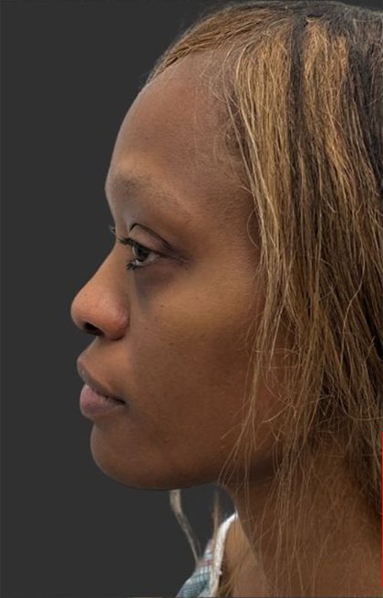Rhinoplasty Before & After Patient #12001