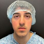 Rhinoplasty Before & After Patient #12093