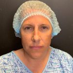 Rhinoplasty Before & After Patient #12094